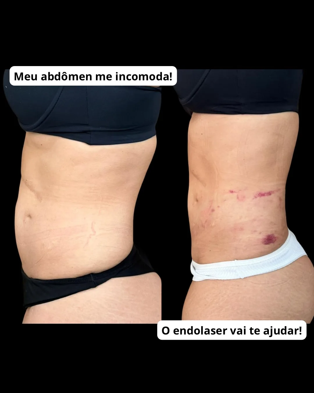 Endolaser