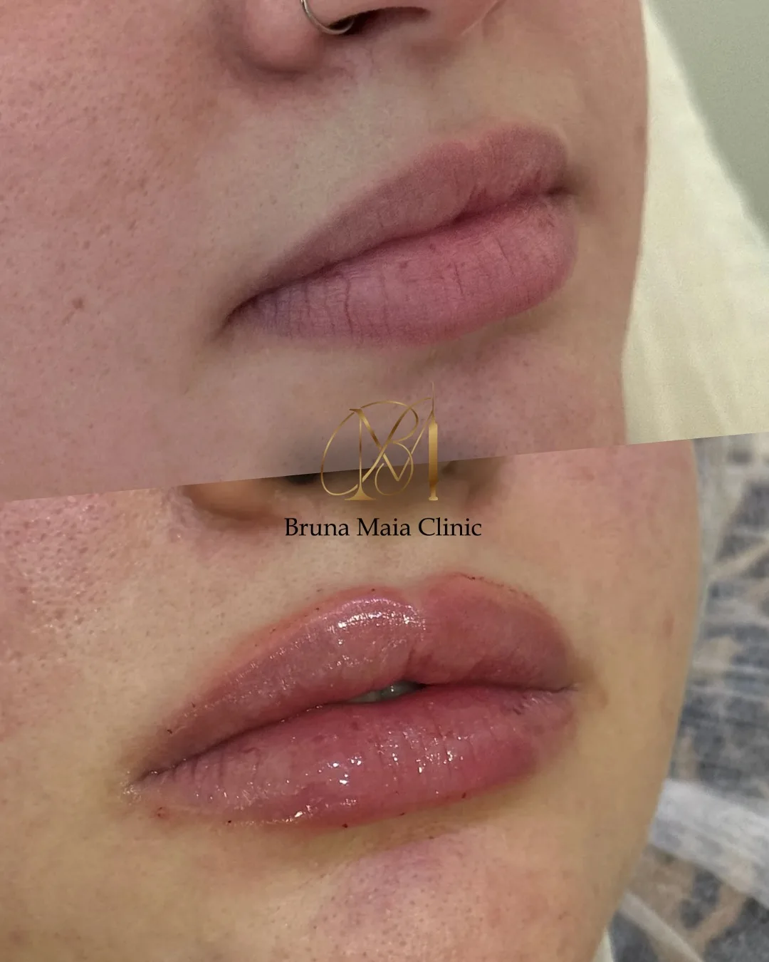 Preenchimento labial, técnica Volumiss, resultado 1