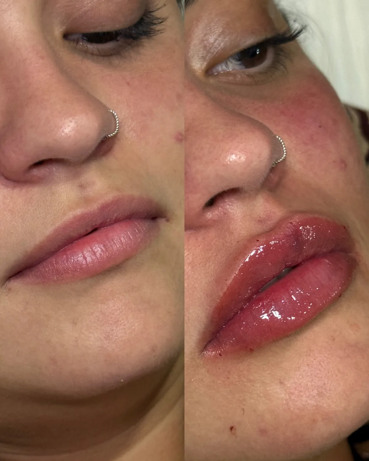 Preenchimento labial, técnica Volumiss, resultado 10