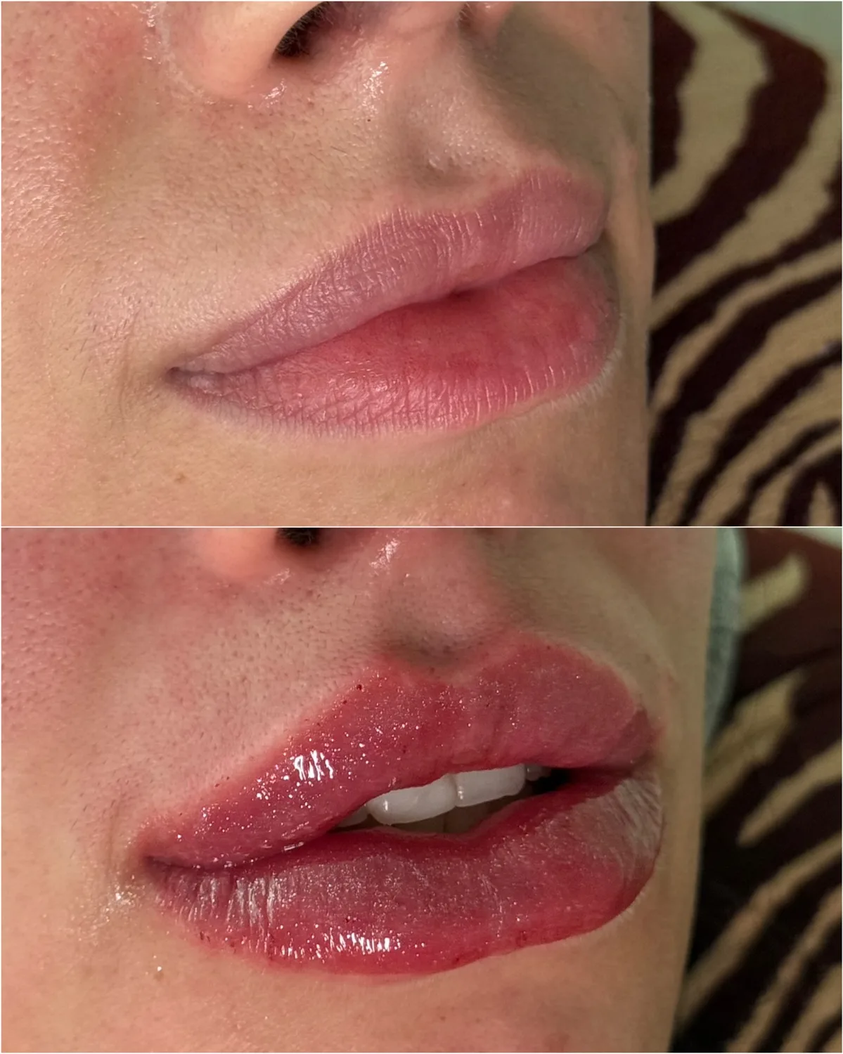 Preenchimento labial, técnica Volumiss, resultado 2