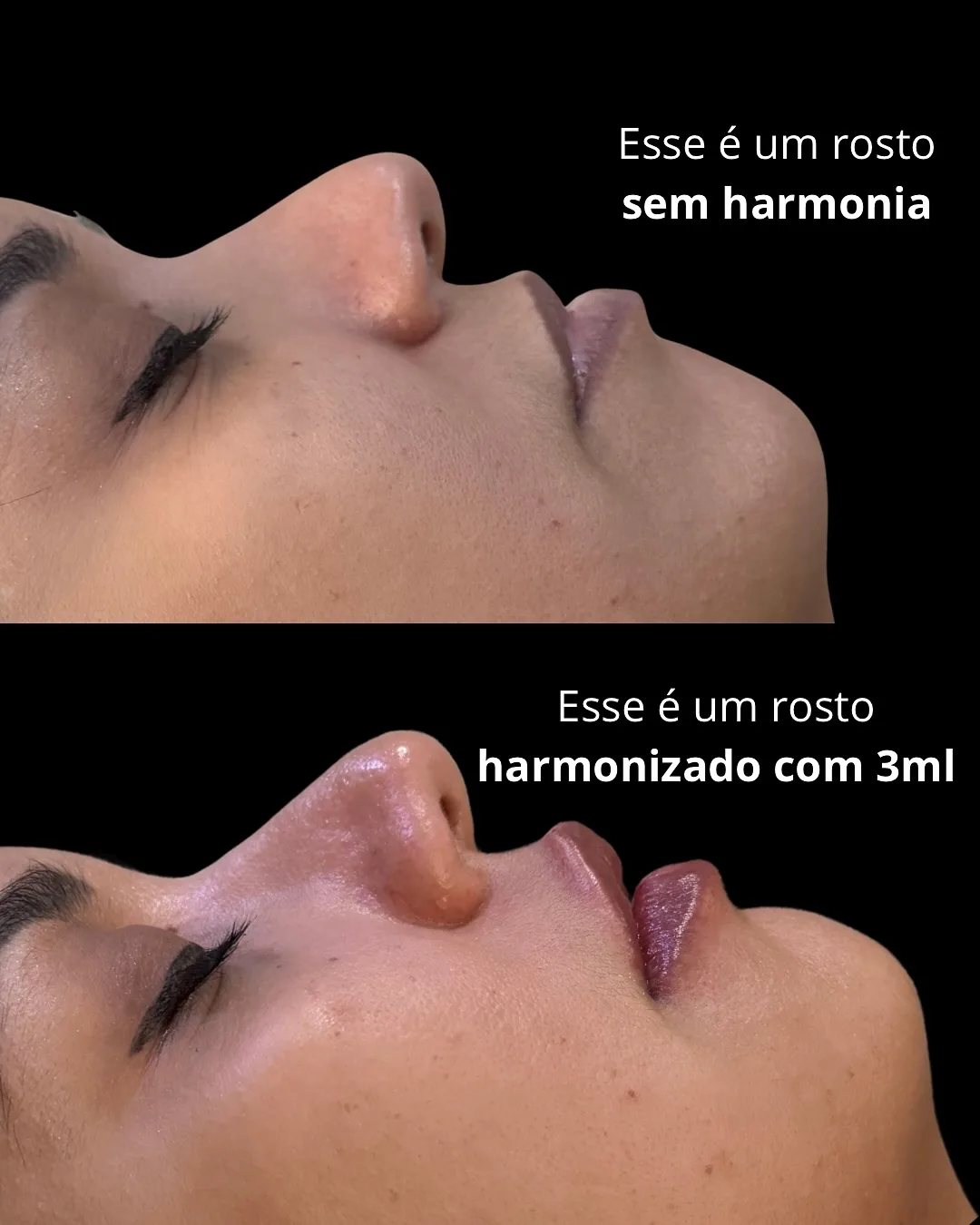 Preenchimento labial, técnica Volumiss, resultado 3