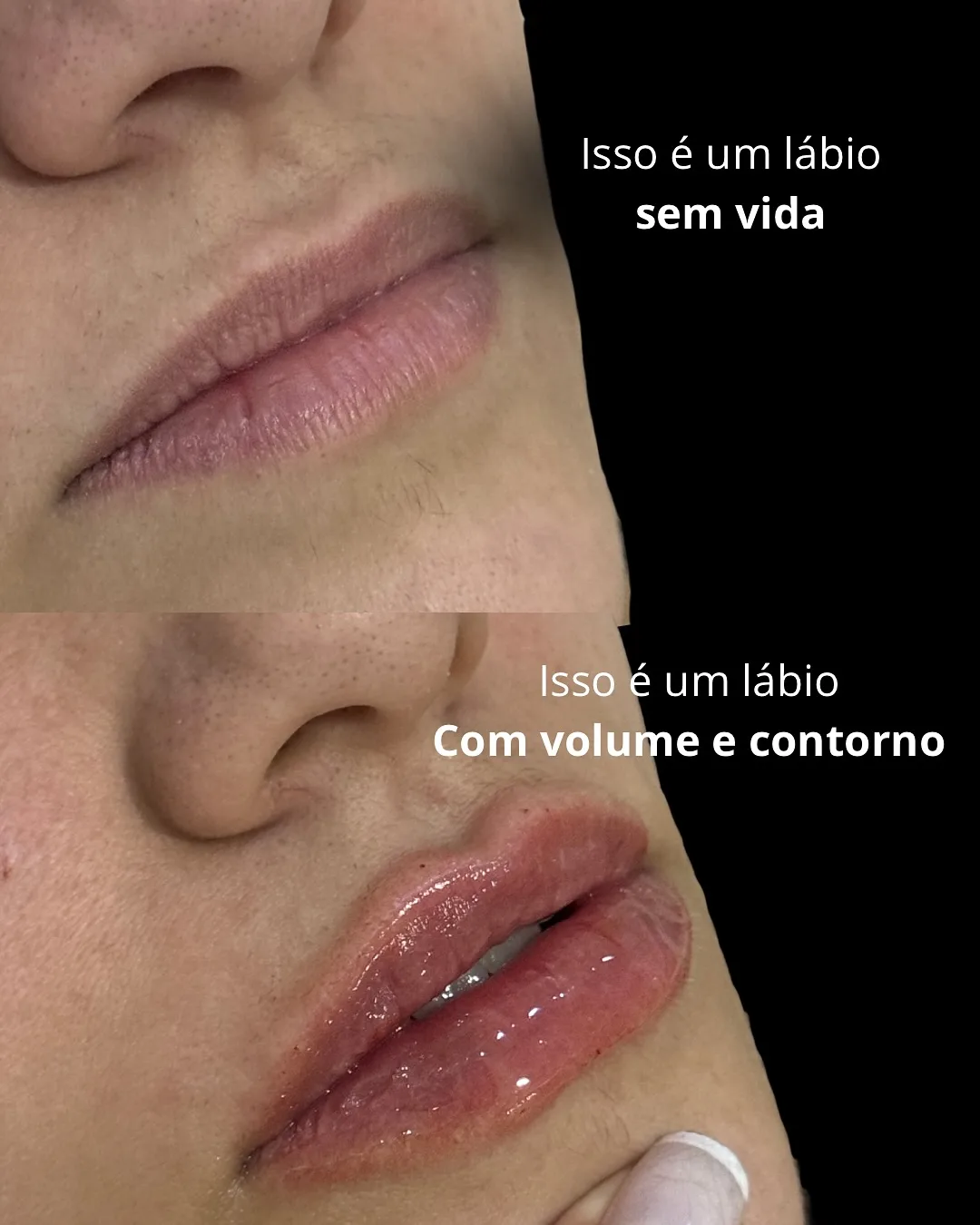 Preenchimento labial, técnica Volumiss, resultado 4