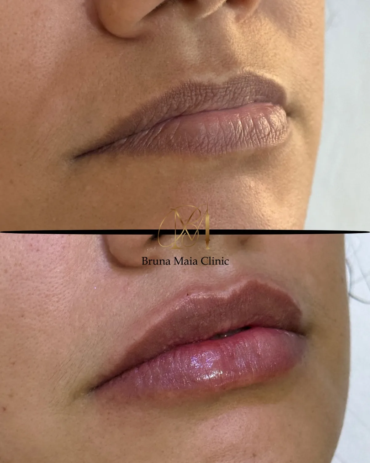 Preenchimento labial, técnica Volumiss, resultado 5