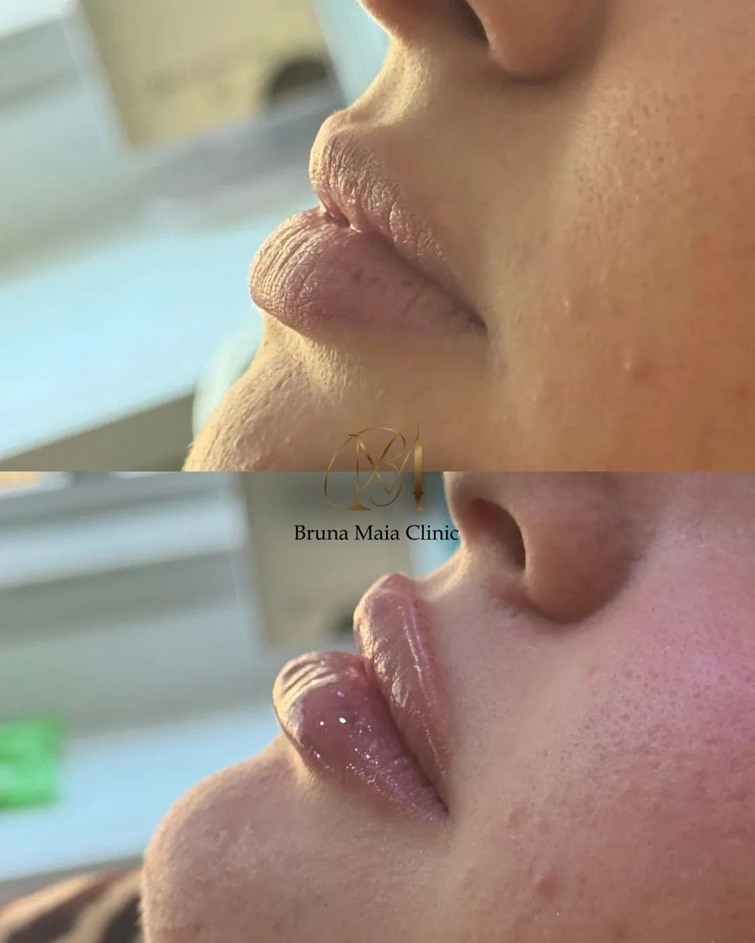 Preenchimento labial, técnica Volumiss, resultado 6