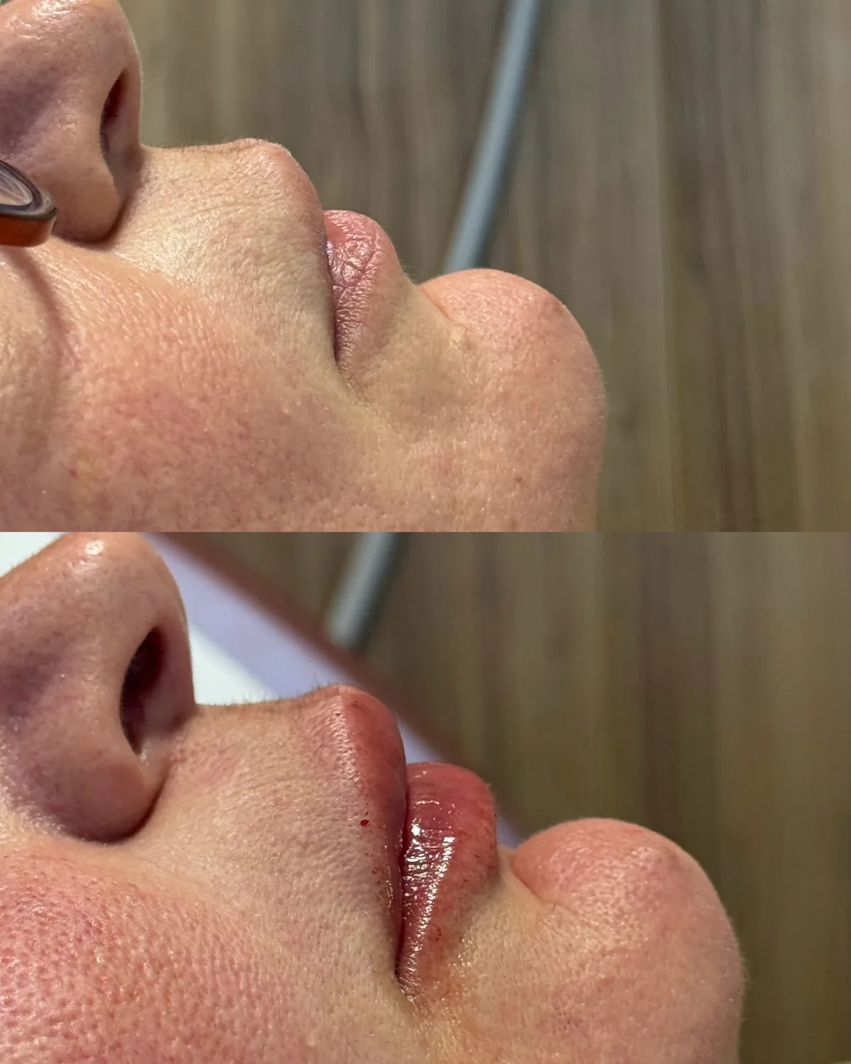 Preenchimento labial, técnica Volumiss, resultado 7