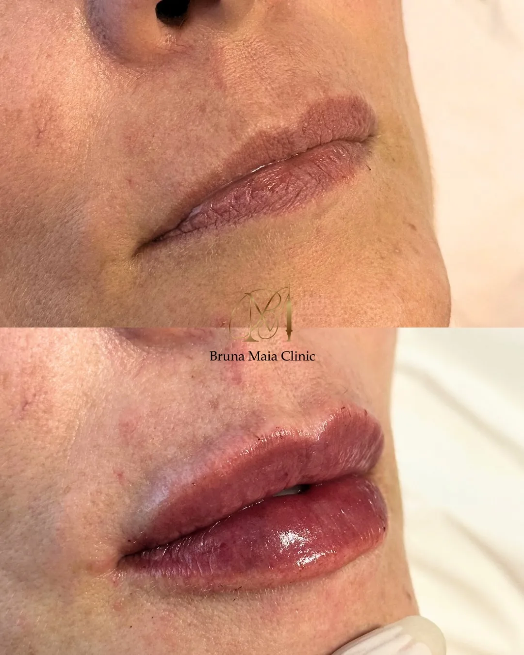 Preenchimento labial, técnica Volumiss, resultado 8
