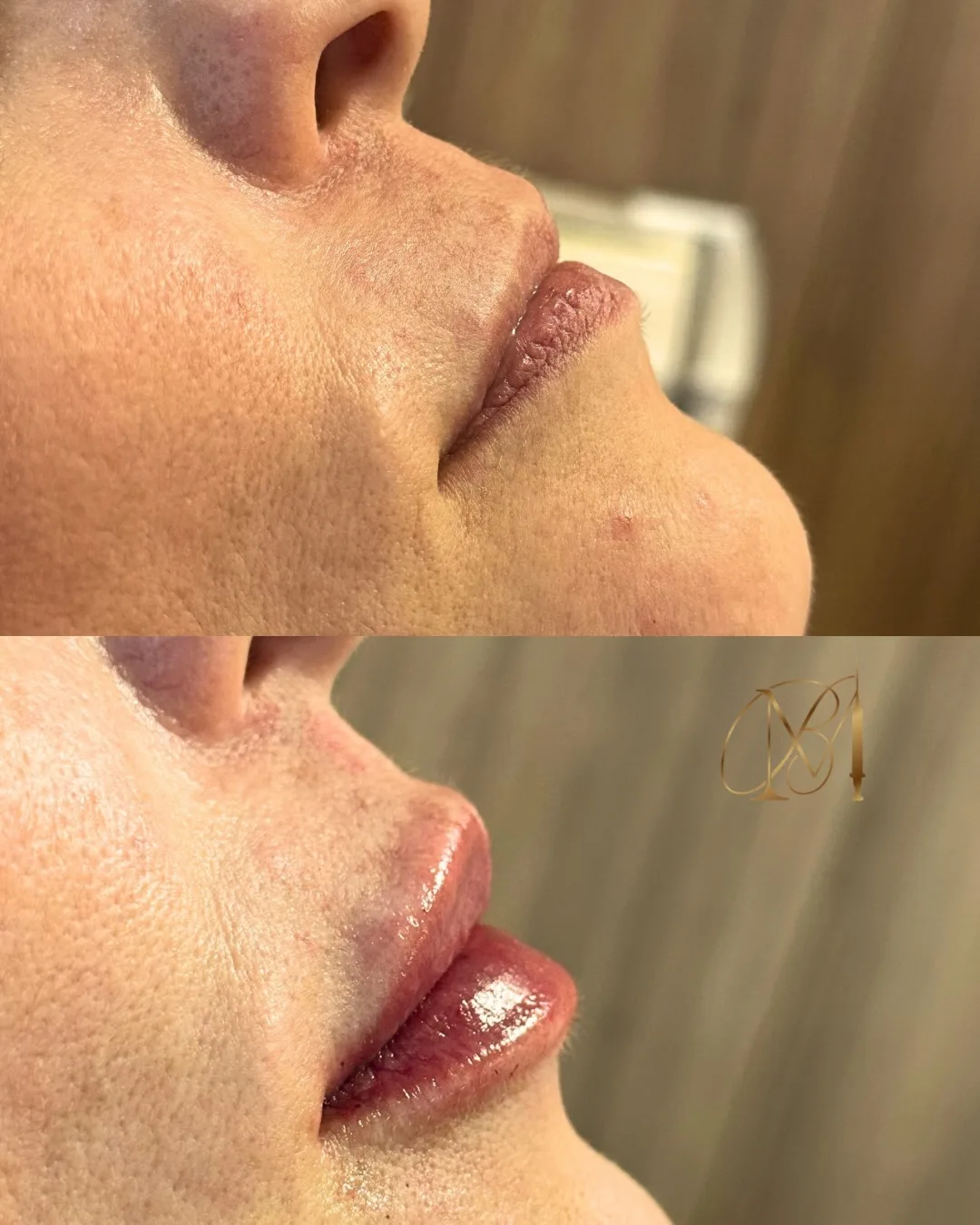 Preenchimento labial, técnica Volumiss, resultado 9